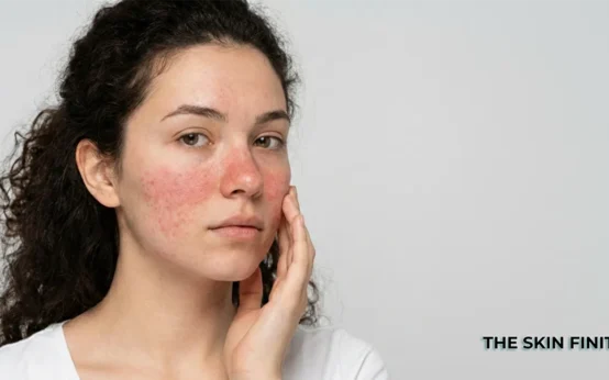 Sensitive Skin Care - TheSkinFinity
